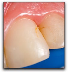 cavity in teeth