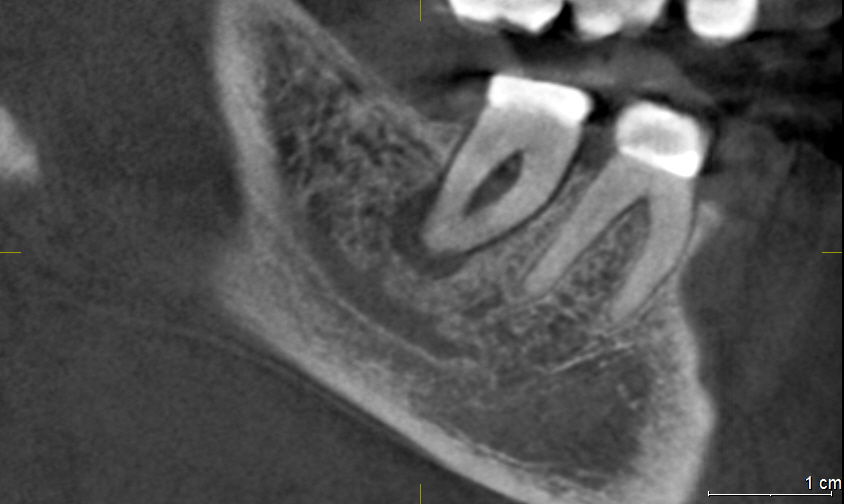 x-ray image of a tooth