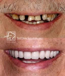 before and after teeth