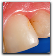 cavity in teeth