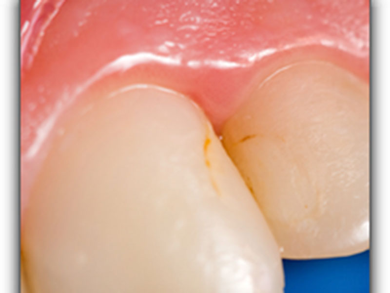 Featured image for “Brush Up on Your Cavity Basics”