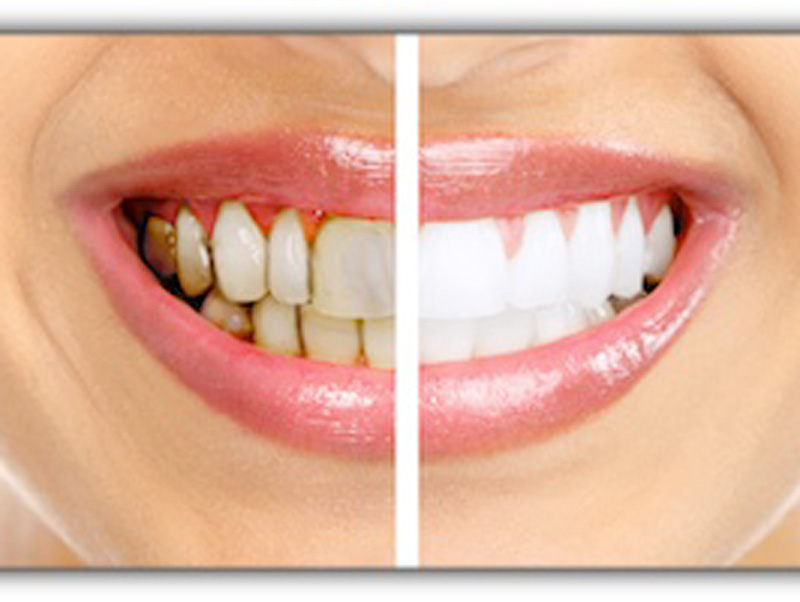 Featured image for “Whitening for 3 Types of Tooth Stains”