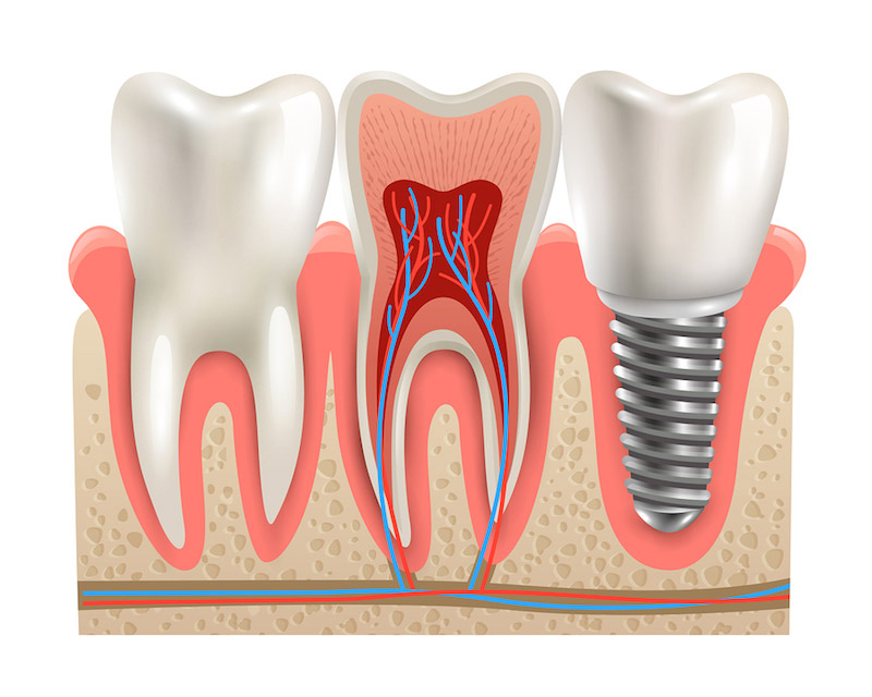 dentist replace back tooth