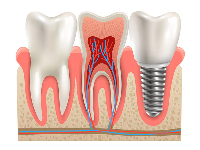Featured image for “Will a Dental Implant Cause a Problem With Airport Security?”