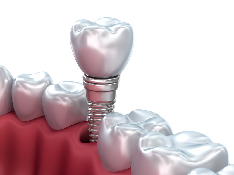 Dental implant