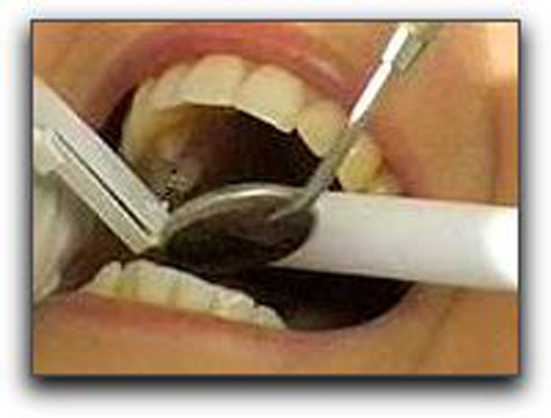 tooth cleaning