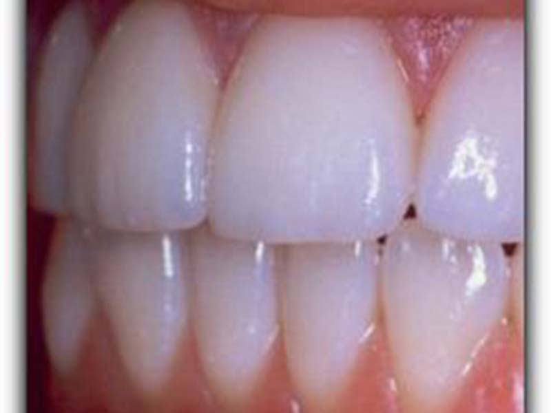 Featured image for “Porcelain Veneers and Instant Orthodontics”