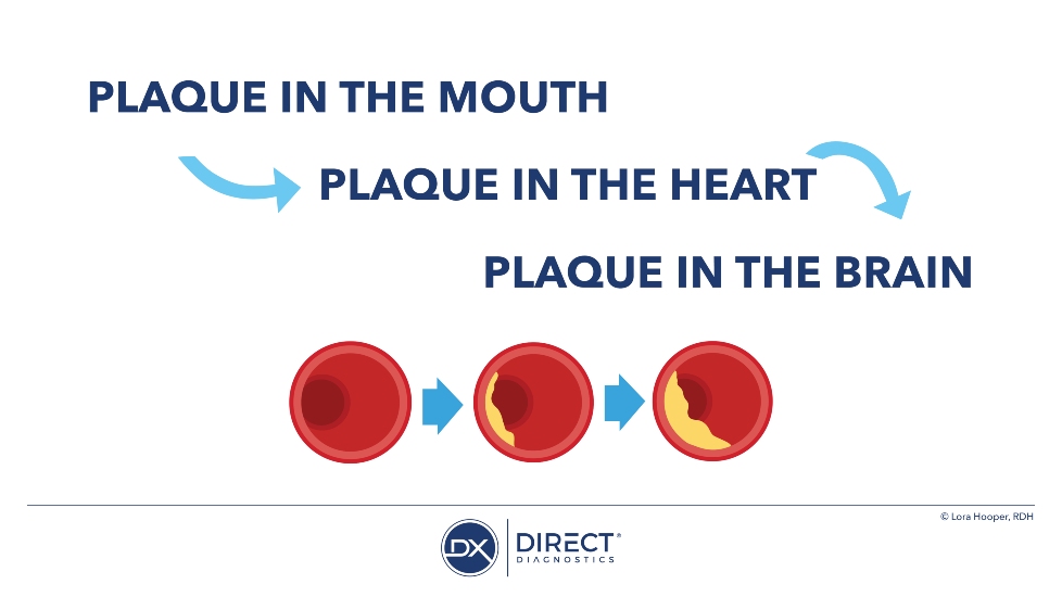 Plaque in the mouth